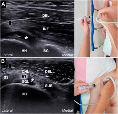 Frontiers | Ultrasound-Guided Hydrodilatation With Triamcinolone